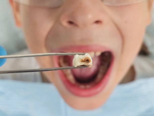 Best Emergency Tooth Extraction in Aloha, OR