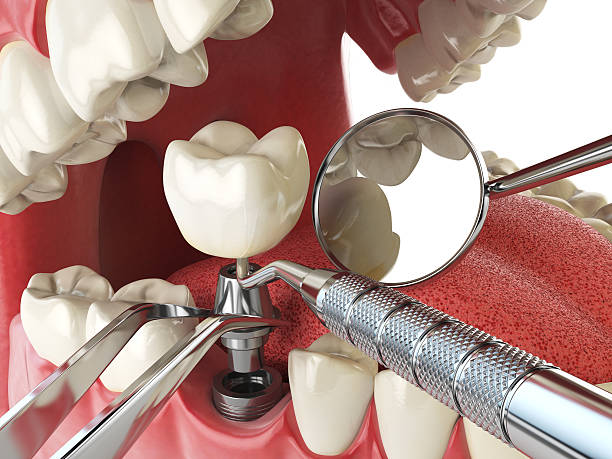 Best Urgent Care for Lost Fillings or Crowns in Aloha, OR